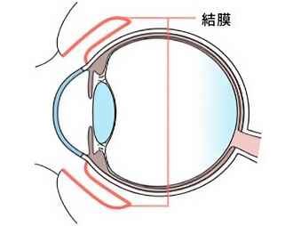 感染性結膜炎のイメージ画像