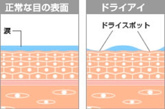 ドライアイのイメージ画像