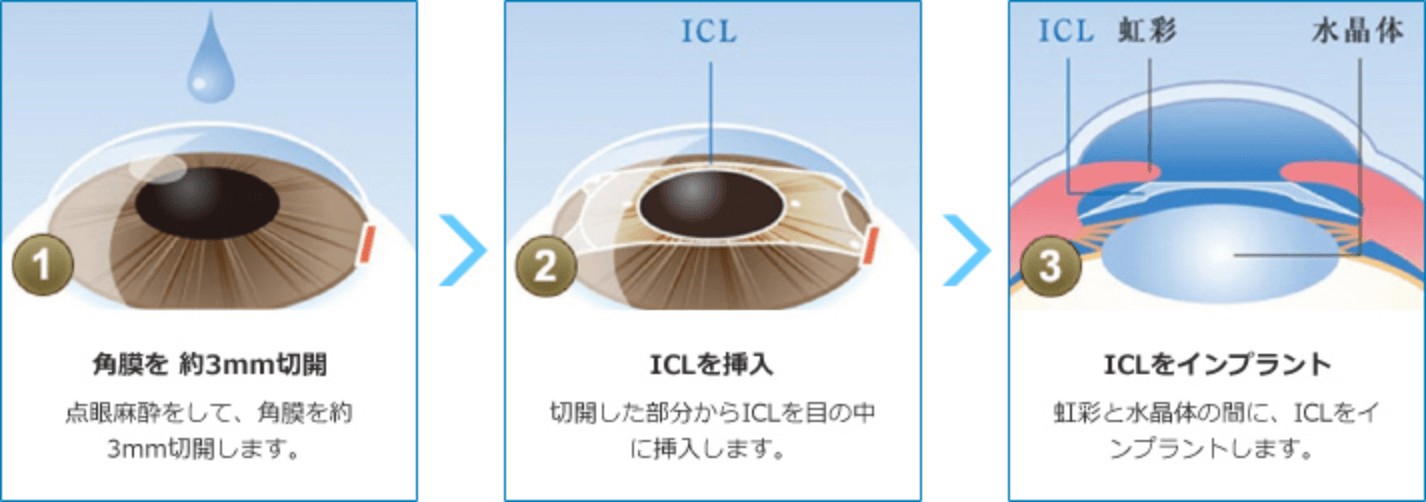 1.角膜を約3mm切開 2.ICLを挿入 3. ICLをインプラント