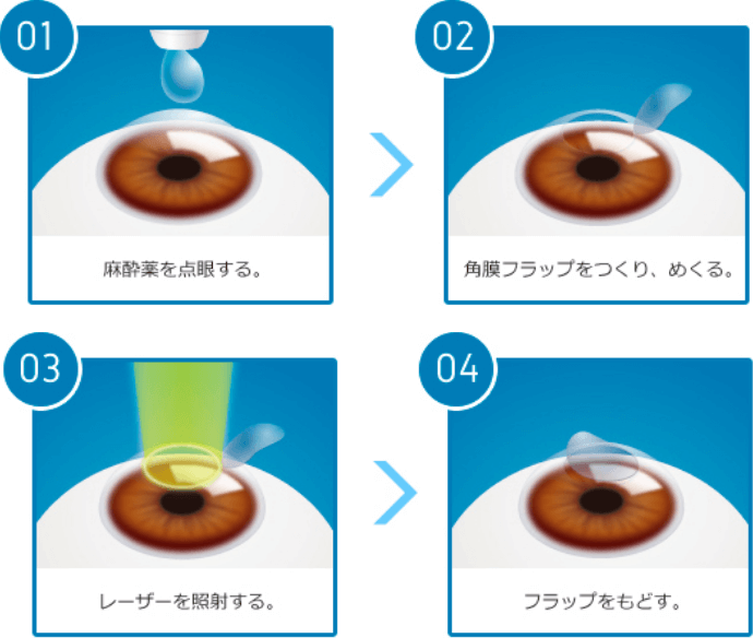 01.麻酔薬をする。02.角膜フラップをつくり、めくる。03.レーザーを照射する。04.フラップをもどす。